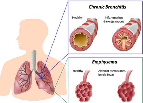 COPD Treatment