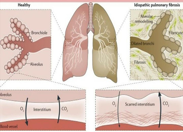 Interstitial Lung Disease