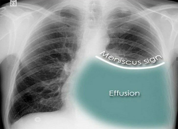 Pleural Diseases
