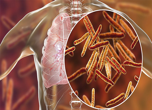 Tuberculosis Treatment